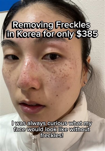 Effective Korean Treatments to Remove Freckles