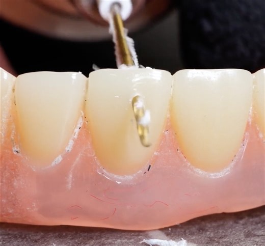 Grillz making process | Patch it