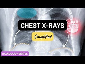 Chest X-Ray (CXR) Interpretation Made Easy | A-E Approach