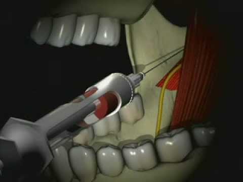 Mandibular Anesthesia - Inferior Alveolar Nerve Block
