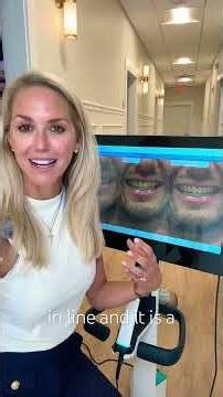 New itero lumina feature with Invisalign. #restorative #invisalign #veneers #itero