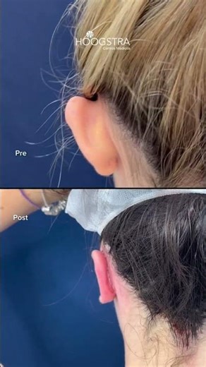 Auriculoplasty using laser