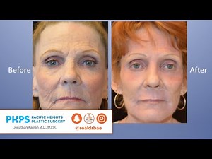 *DEEP CHEMICAL PEEL* Procedure & Healing! | Pacific Heights Plastic Surgery – Dr Bae!