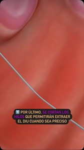 ⚠️ ¿Cómo se inserta un DIU paso a paso? El enfoque sistemático para la inserción de un dispositivo intrauterino (DIU) debe seguir una serie de pasos bien definidos para asegurar la correcta colocación y minimizar complicaciones: 1️⃣ Preparación: - Confirmar la ausencia de embarazo y verificar que no existan contraindicaciones para el uso del DIU. - Realizar un examen bimanual para determinar el tamaño, la forma y la posición del útero. - Colocar a la paciente en posición de litotomía y visualiza