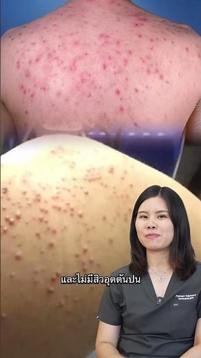 ทำไมสิวตุ่มแดงๆตามตัวไม่หายสักที #หมอผึ้งey #หมอผึ้งหลุมสิว #สิว #สิวยีสต์ #สิวหลัง #สิวที่หลัง