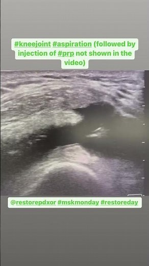 ultrasound guided knee effusion aspiration