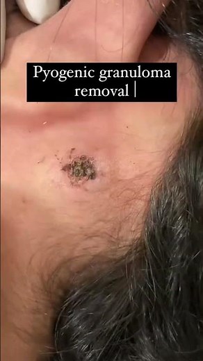 Pyogenic granuloma removal/Pyogenic granuloma/co2laser/laser treatment/laser/dermatologist Surat