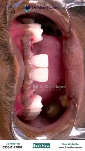 Front Teeth Implant Transformation | Watch This Smile Makeover | Dental Implants | Before & After