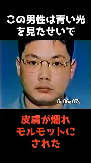 [True Story] My younger brother was exposed to radiation, his skin became rotten, and he was used...