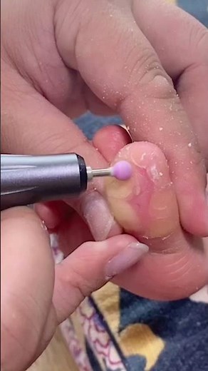 【掌蹠角化症】フットケア 角質除去 ⚠️サロンワークではありません。