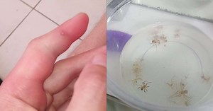 Foi picado por uma aranha? Saiba o que fazer para evitar o agravamento