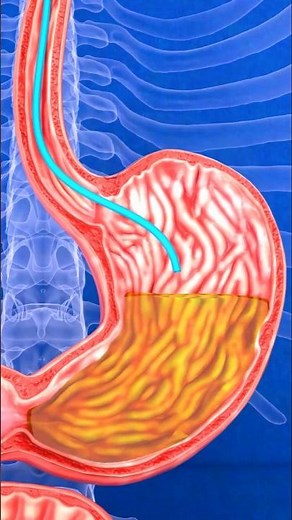 How a Nasogastric Tube Feeds You Safely NG Tube Explained