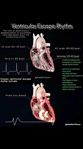 Ventricular Escape Rhythm (Idioventricular Rhythm) A ventricular escape rhythm is a life-preserving, default cardiac rhythm that emerges when there is failure of higher pacemakers. It occurs when the rate of supraventricular impulses arriving at the ventricles falls below the intrinsic firing rate of the ventricular pacemaker cells. Pacemaker Hierarchy & Intrinsic Rates: · SA Node: 60–100 bpm · AV Node (Junctional): 40–60 bpm · Ventricles: 20–40 bpm Mechanism: When impulses from the SA and AV no