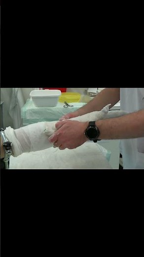 Thumb Spica Cast — Step by Step | OrthoCastLab