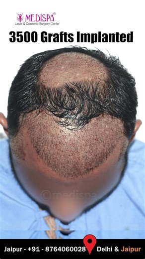 Natural Hairline Hair Transplant Results | Aesthetic and Undetectable | Dr Suneet Soni