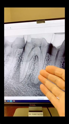 No cbct. #dentists #rootcanaltherapy #apexdental #dentalartistry #dentalcare #dentist