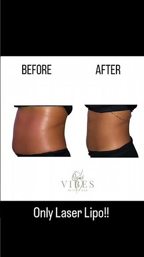 Laser Lipo!! Before And After! | Noninvasive Body Sculpting!