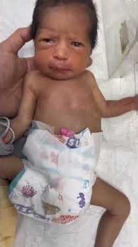 Floppy Baby Syndrome 🚨 NICU