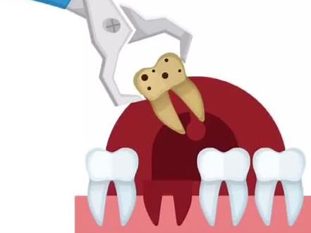 拔牙和拔牙后注意事项