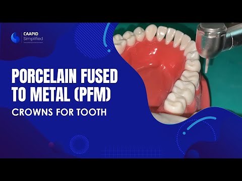 Porcelain Fused to Metal (PFM) Crowns for Tooth #30 | Caapid Simplified Bench Prep Course