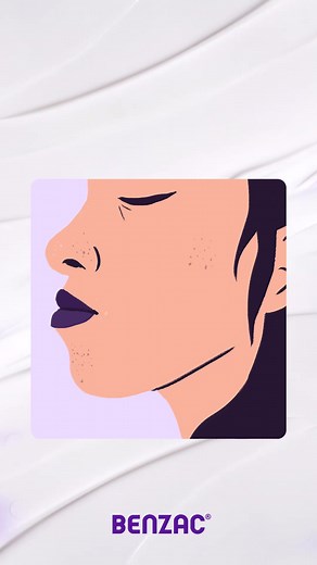 Benzac AC Gel Spot Treatment: The Ultimate Solution for Acne