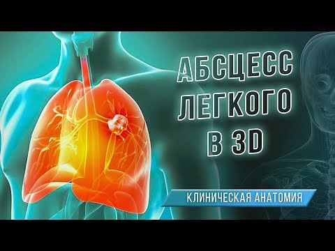 Абсцесс лёгкого в 3D. Клиническая анатомия