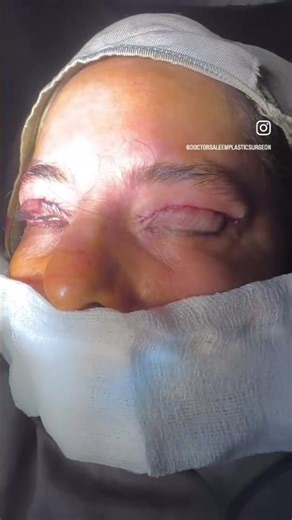 Blepharoplasty surgery in lahore Pakistan by dr Saleem