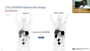 Theranostics: Successes and Challenges in Targeted Radiotherapy