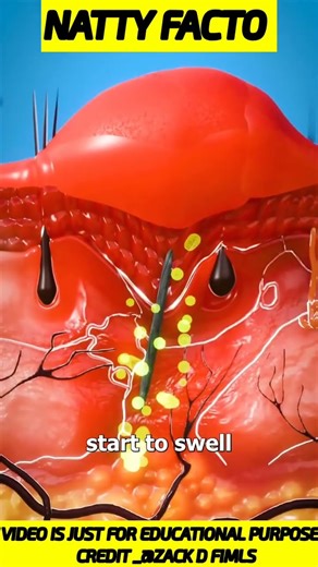 what to do if thorn stuck into the skin| @nattyfacto | #short