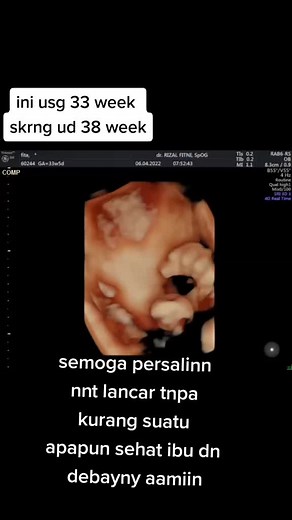Understanding Fetal Development at 33 Weeks Gestation