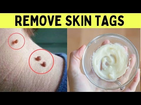 How to remove skin tags painlessly from eyelids in one night at home