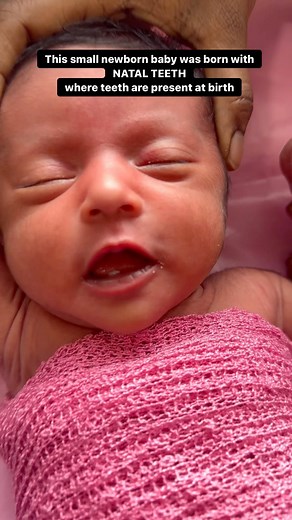 511K views · 4.3K reactions | Natal teeth / neonatal teeth.. We need to extract when it interferes with breastfeeding ..as it is going to affect the overall growth of baby.. A big big salute to the baby and his parents .. Thank you .. . . #drparthsoni #teething #toothextraction #newborn #newbornbaby #momsofinstagram #teeth | Parth Soni | Facebook
