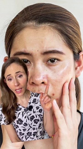 Understanding Oily Skin: Hormones, Genetics, and Skincare Myths