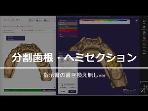 how to exocad 分割歯根 ヘミセクション対応