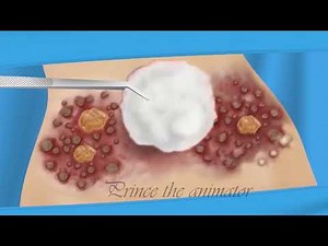 What happens if worm enters belly button | belly button cleaning ASMR| Project done for a client