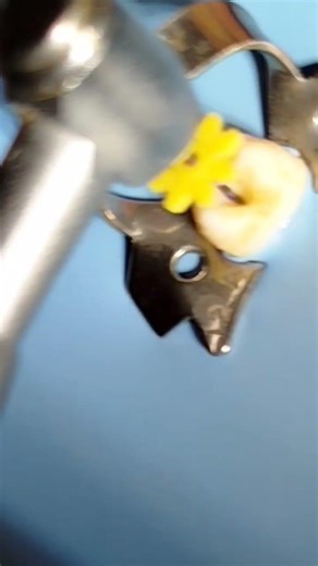 Root canal therapy #endodontics #shorts