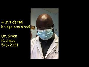4 unit dental bridge explained