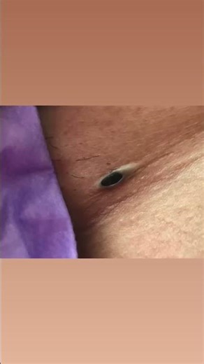 Watch These Satisfying Cyst Popping Clips 81