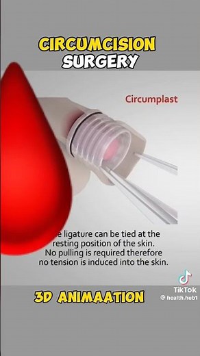 Understanding Circumcision: Animated Surgery & Real Insights"