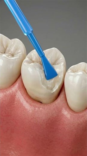 Tooth Structure Repaired 🦷 Composite Fill 3D Animation