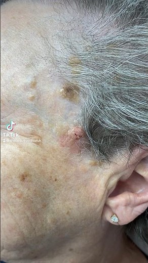 Amazing Skin Transformation! Wart removal… RESULTS! 🤩