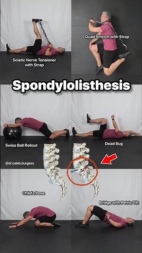 Lumbar Spondylolisthesis - Low Back Pain Relief Exercises