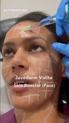 It was Volite Skin Booster! This hyaluronic acid injection stimulates collagen + elastin! #skincare