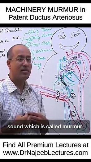 MACHINERY MURMUR In Patent Ductus Arteriosus #shortvideo #shorts #drnajeeb #lecture