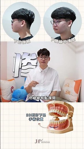 客製化下巴整形｜3D列印下巴墊片案例心得 #傑尼斯醫美
