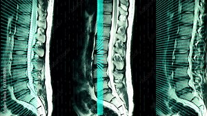 An MRI scan of lumbar and sacrum of a patient with herniated disc with grid of blue green lights animation of the scanning process.