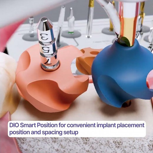 Revolutionary Implant Surgery Tools: UNICON Kit Launch! #dioimplant
