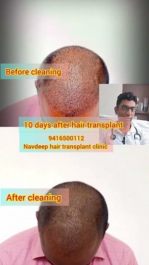 10 Days After Hair Transplant: Scab & Crust Removal Process by Dr. Navdeep Goyal MBBS DNB