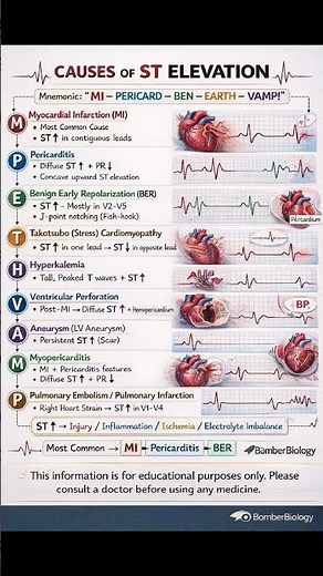 the major causes of ST elevation on an ECG. It is designed for quick recall and deeper understanding