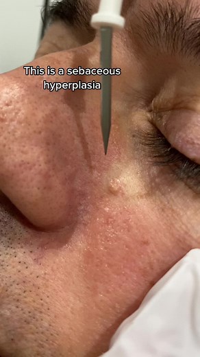 Sebaceous Hyperplasia removal performed by Dr Shukla! 👨‍⚕️ #dermtok #dermatologist #removalvideo #removal #satisfying #closeup #gross
